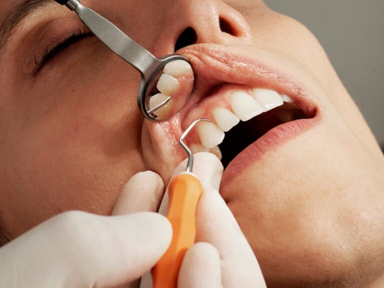 Type 2 Diabetes Heightens Gum Disease Risk, Even With Controlled Blood Sugar