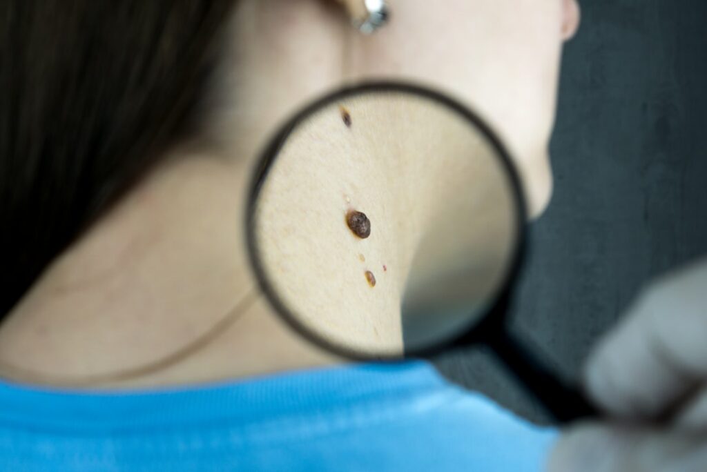 dermatologist examining skin — Vitalheros