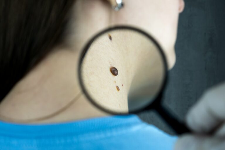 Navigating Facial Rashes: Differentiating Steroid-Induced Conditions