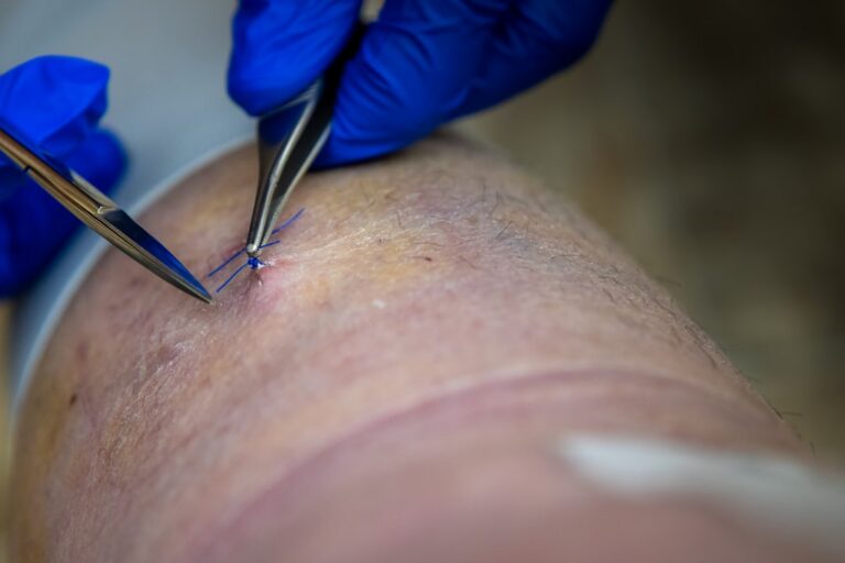 Cracking the Code: A Molecular Pathway in Diabetic Wound Healing