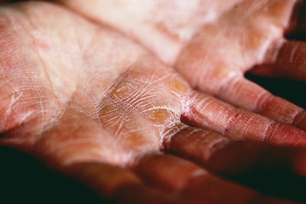 age spots hand — Vitalheros