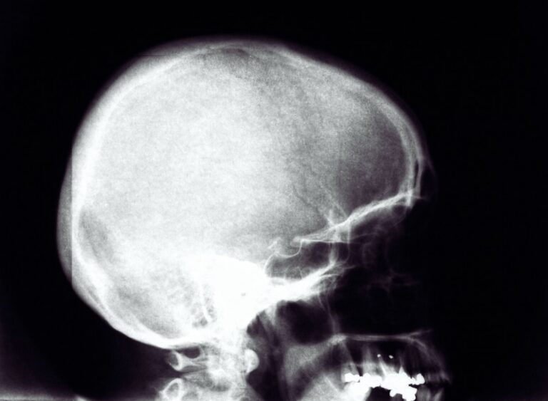 Engineered Scaffold Offers New Hope for Craniosynostosis Treatment
